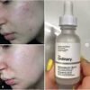 The Ordinary Niacinamide 10% + Zinc 1 % – 30ml - Image 5